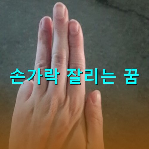 사고로-새끼-손가락이-없는-안타까운-모습