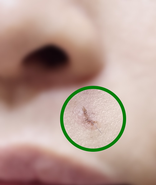 얼굴 피지낭종 제거 후기