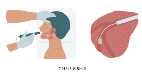 타석증이란&amp;#44; 타석증 증상 수술 치료&amp;#44; 수술입원기간 알아보기(최신) 