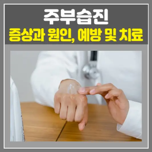 주부습진 증상과 원인, 예방 및 치료