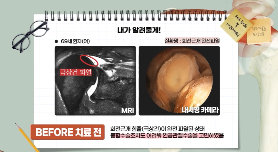 어깨가 아파요