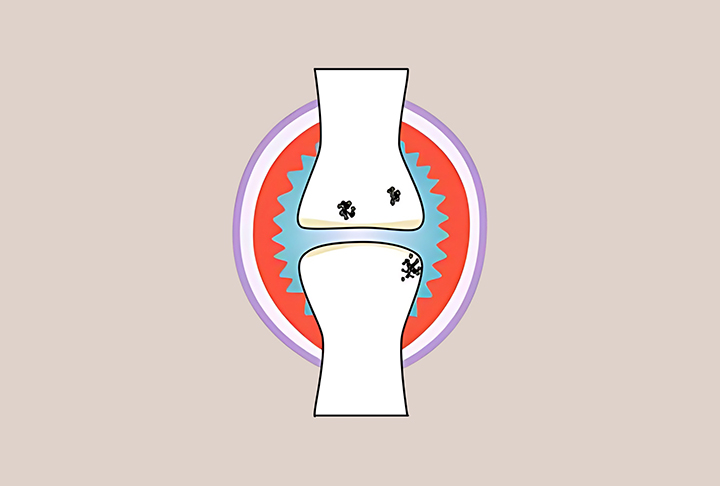 관절염-모습