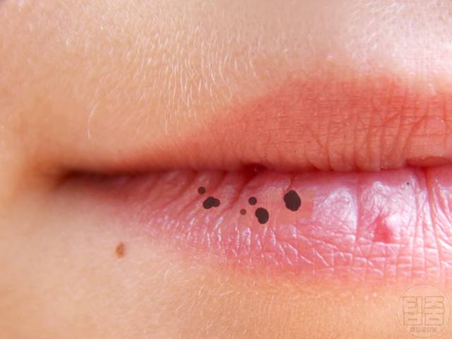 입술 검은점 기미 피부암 철분과다