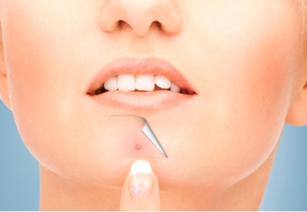 부위별 여드름 원인