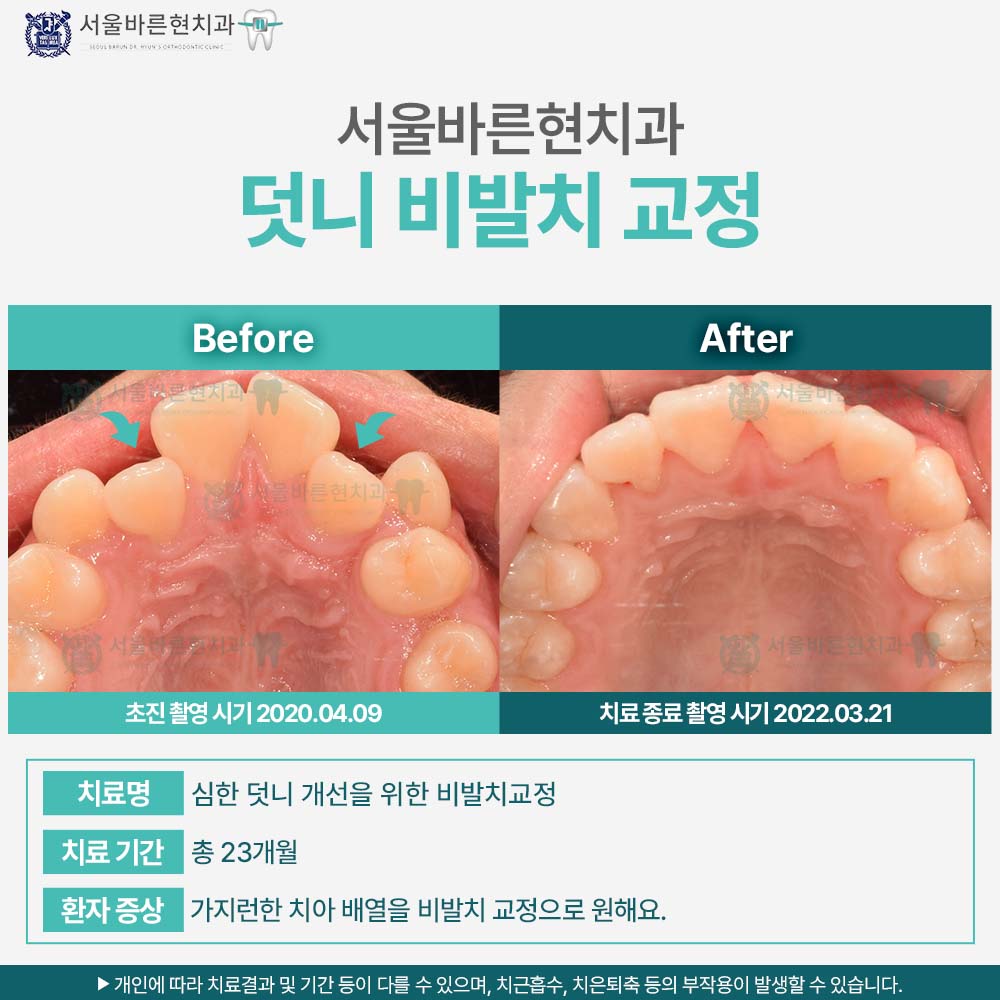 부산치아교정