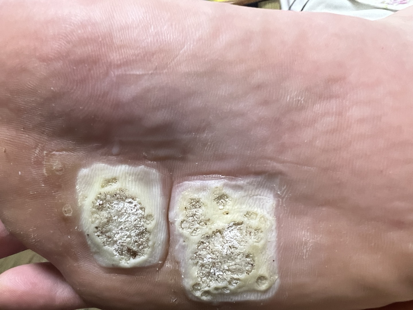 발바닥사마귀 티눈밴드