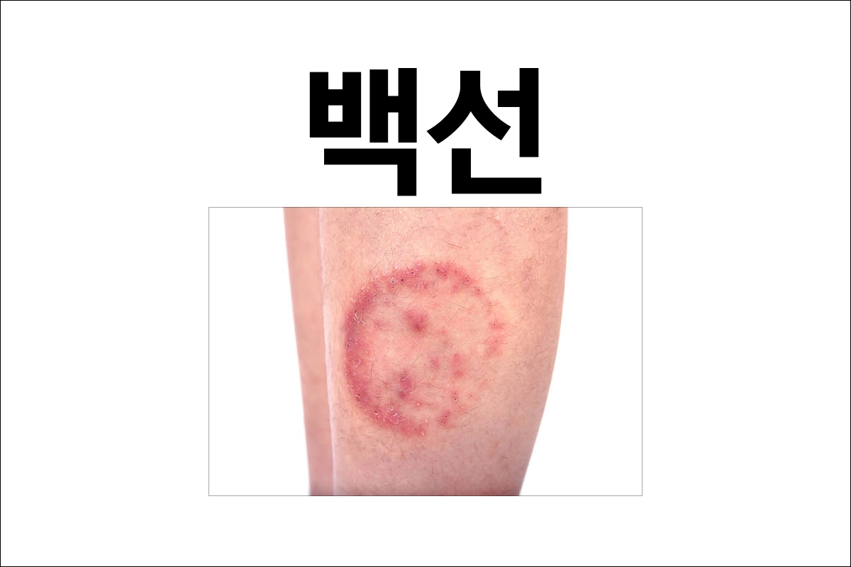 백선 종류 원인 감염 경로 증상 진단 치료 예방