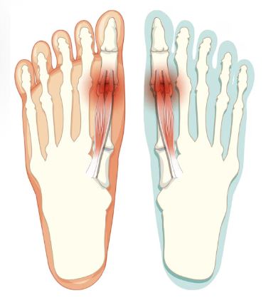 통풍 빨리 낫는 방법