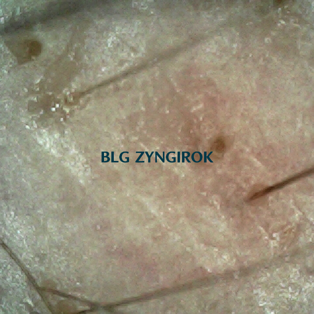 탈모 극복 프로젝트 - 오른쪽 M자 부위 두피 모습이다.