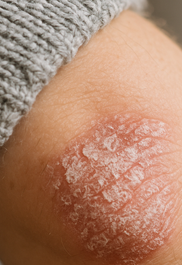 건선 피부염 완전정리