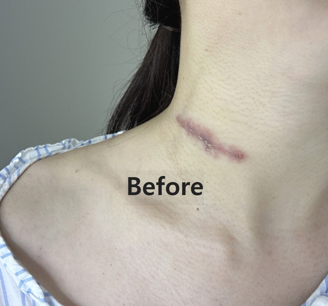  갑상선 암&amp;#44; 림프절 암 수술 흉터 관리 - 더마매직