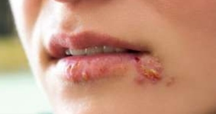 입술이 부르트는 이유 영양 결핍