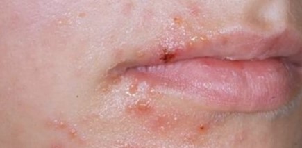 헤르페스 1형 전염과 원인