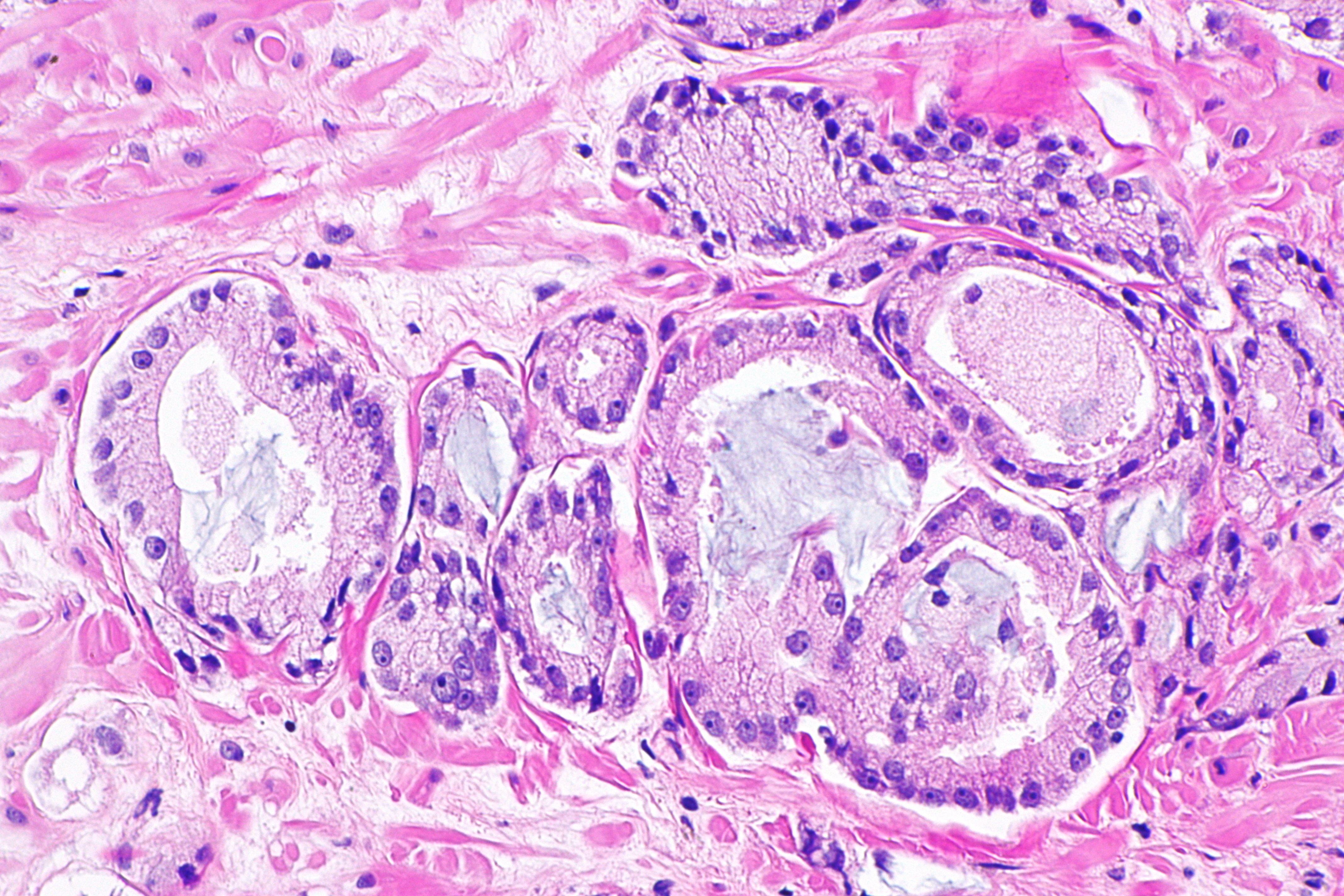전립선암-초기증상