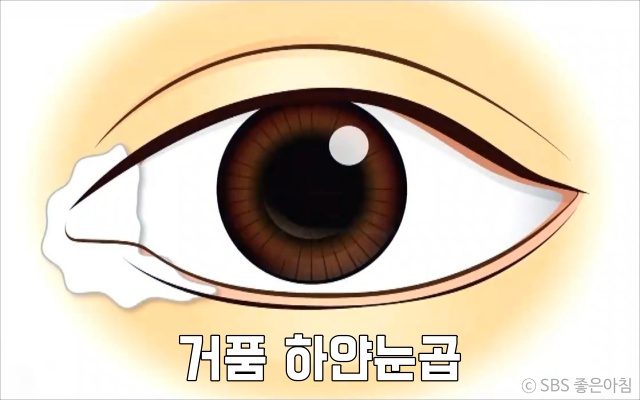 거픔 하얀 눈곱이 끼는 이유 눈질환 다래끼 눈꺼풀염 면역력이 떨어졌을때 증상, 건강 팁줌 매일꿀정보