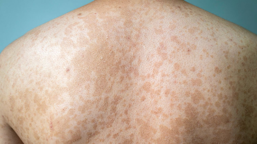 백반증 완벽 가이드