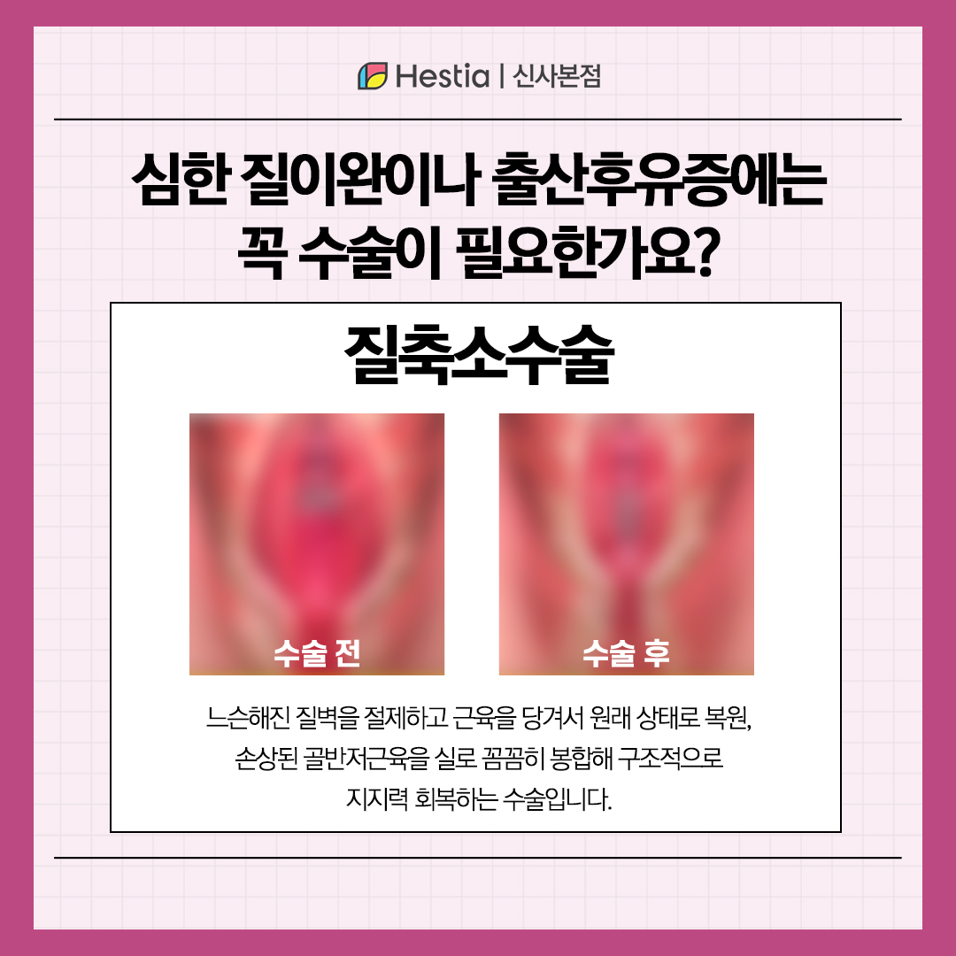 증상 심하면 질축소수술 꼭 필요한가요?
