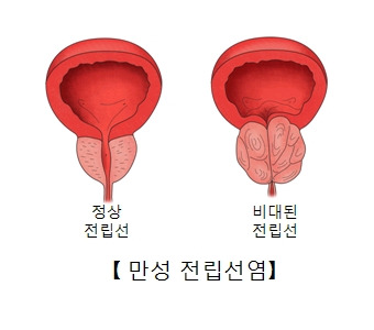 전립선염 증상