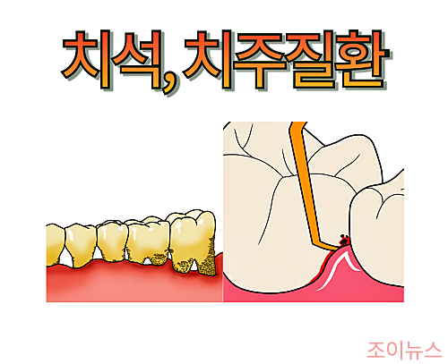 스케일링, 꼭 받아야 하는 이유_치석/치주질환