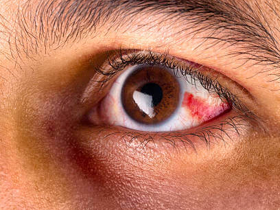 눈 실핏줄 터짐 이유와 증상 및 치료 방법