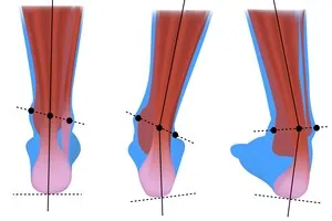 아킬레스건-통증