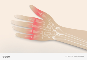 손가락 류마티스 관절염 증상