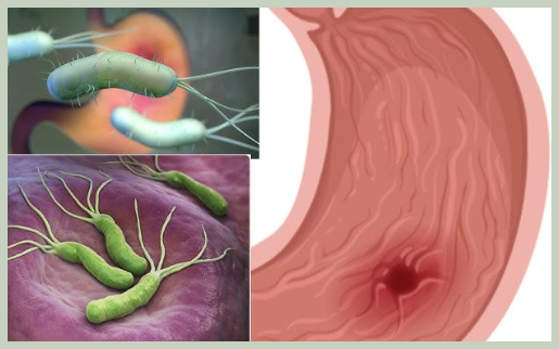 헬리코박터균 감염 원인