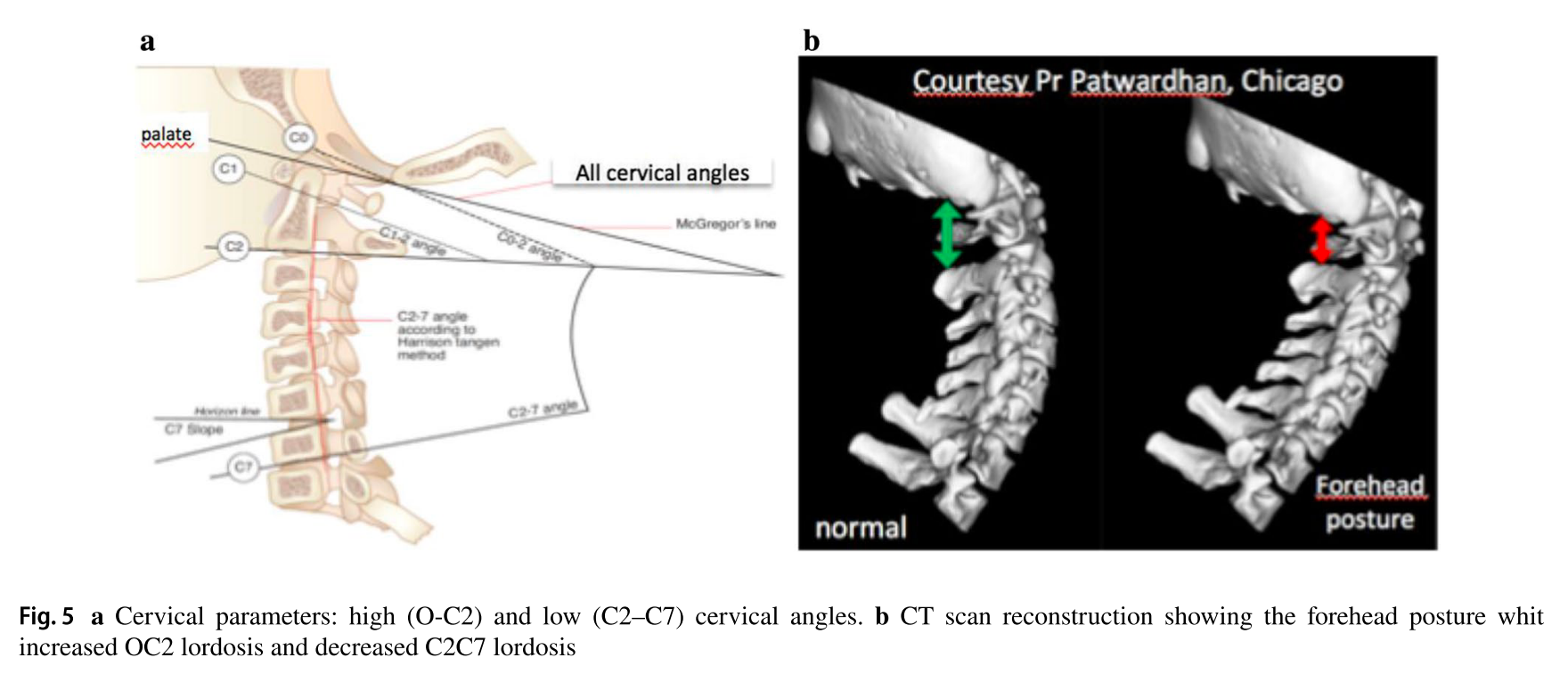 경추 관련 매개 변수