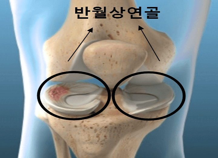 무릎 사진 썸네일