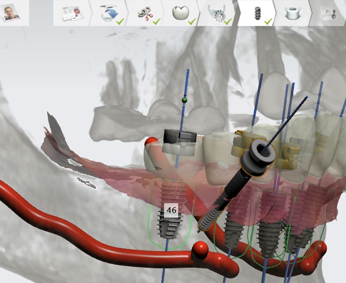 디오 임플란트 디오나비 3D 구강스캔&amp;#44; 3D 컴퓨터 모의시술