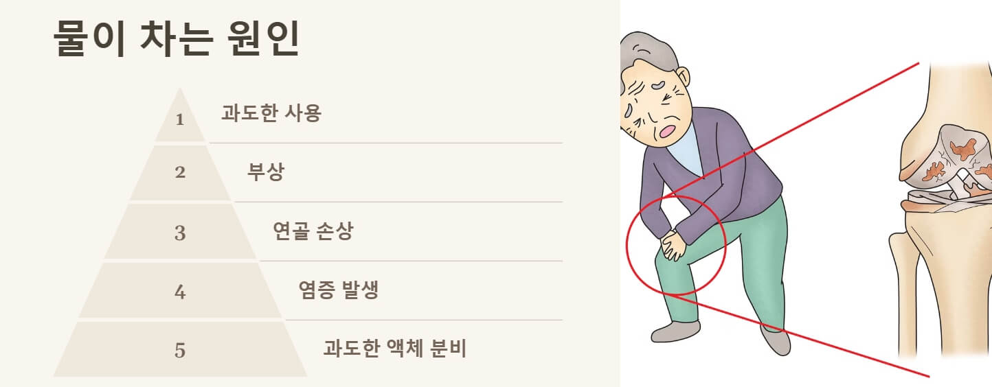 무릎에 물이 차는 증상