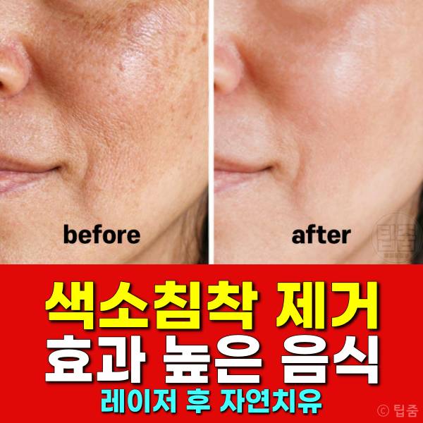 색소침착 제거 좋은 음식,색소침착 레이저 후기,색소침착 자연치유