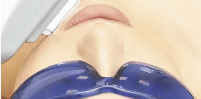 안면홍조 vs 주사피부염&amp;#44; 닮았지만 완전히 다른 빨간 얼굴 고민~!