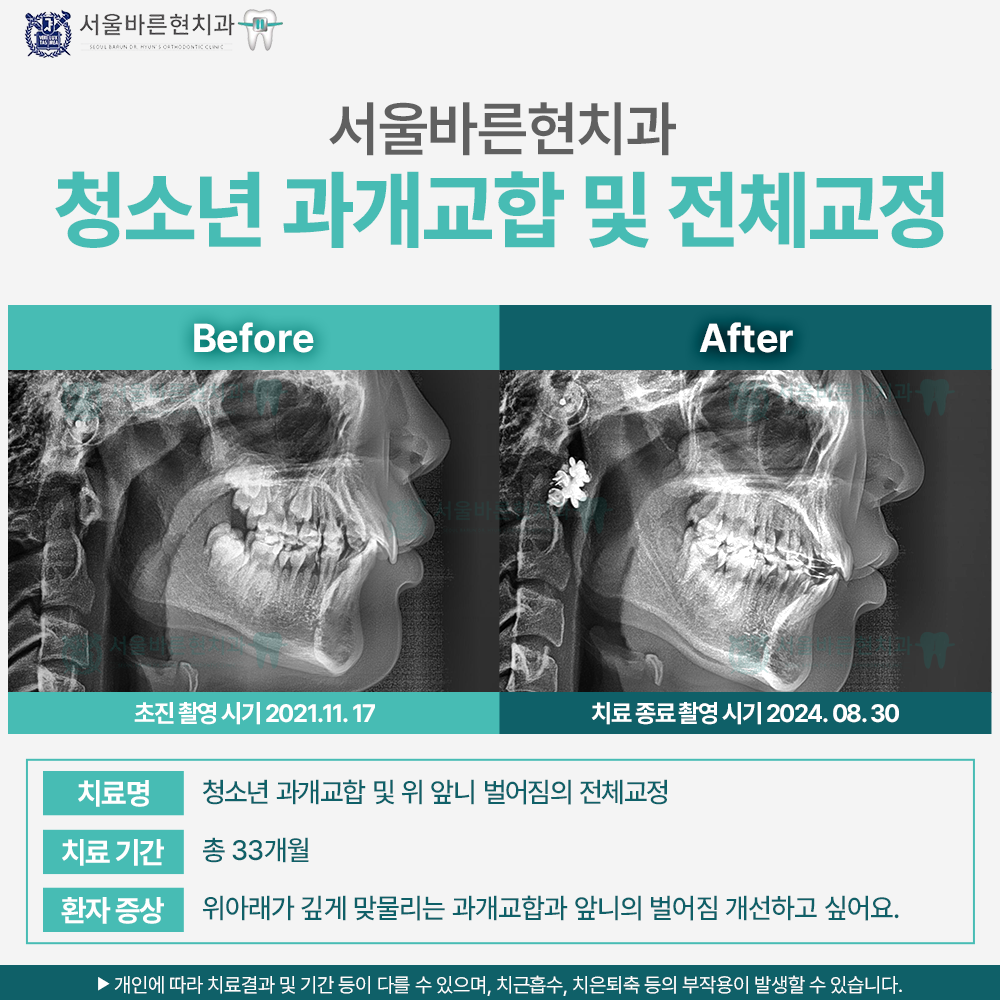 부산치아교정