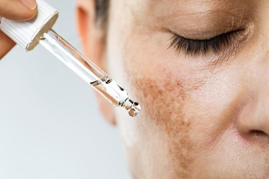 색소침착 (Hyperpigmentation) – 원인, 치료법, 시술 비교
