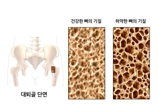 건강한 뼈&#44; 허약한 뼈