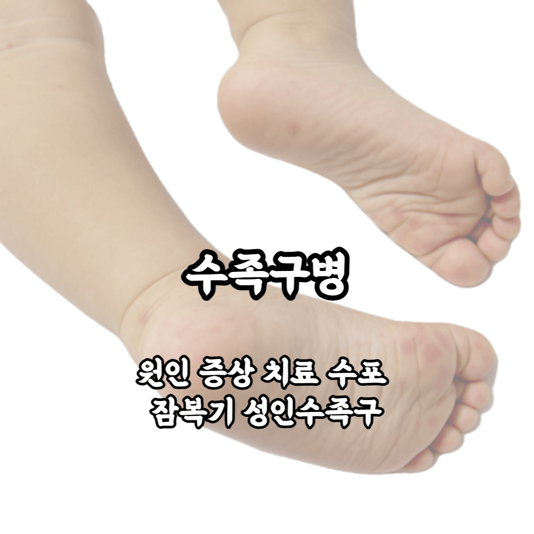 수족구 아기수족구 원인 증상 치료 수포 잠복기 성인수족구