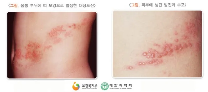 대상포진 병원어떤과로가나요