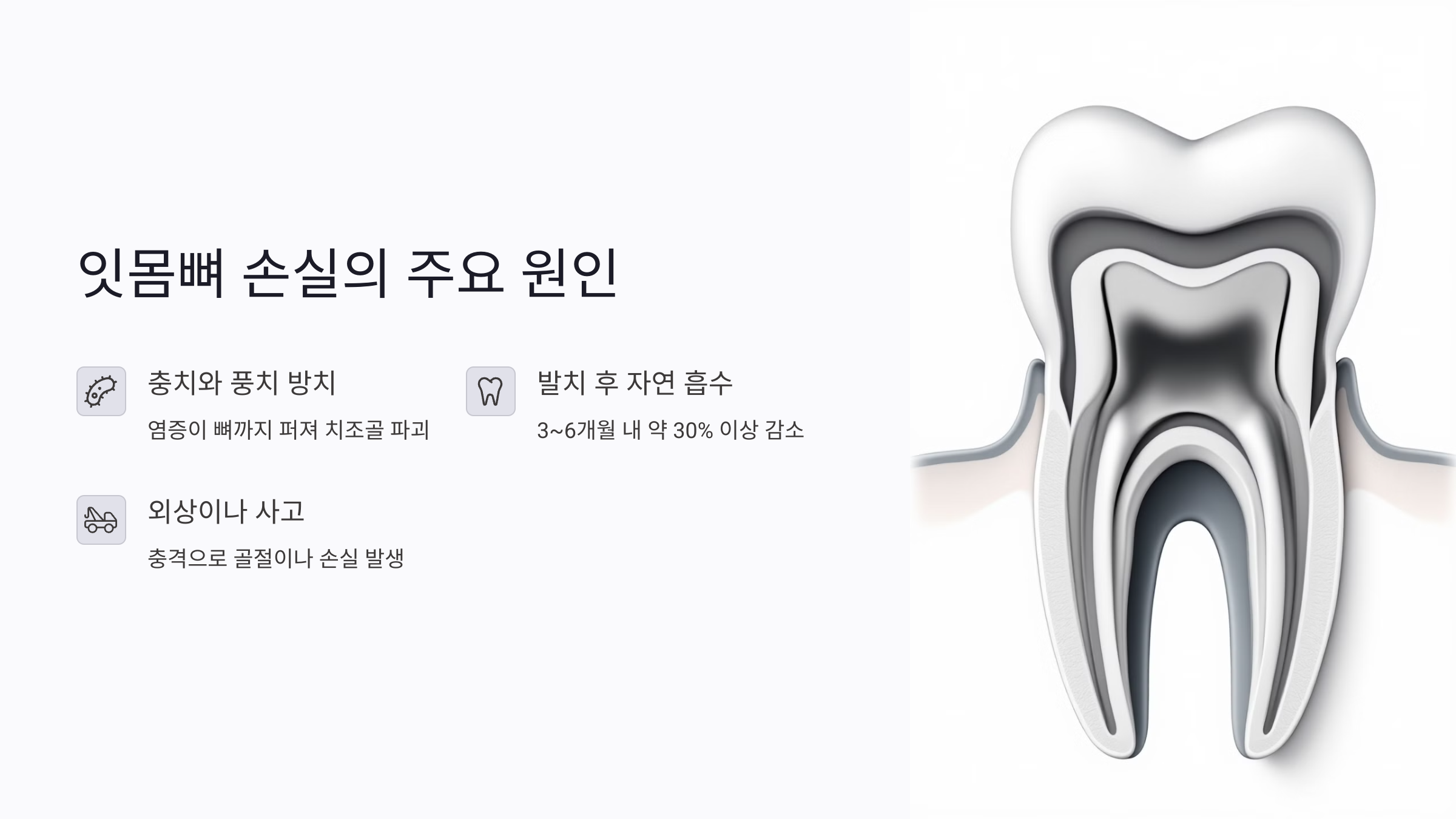 잇몸뼈 부족으로 임플란트가 안된다고요? 인공뼈이식으로 해결하는 재건법