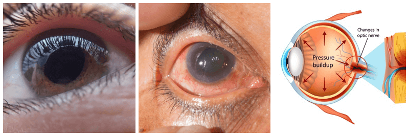녹내장 관련 사진 3개