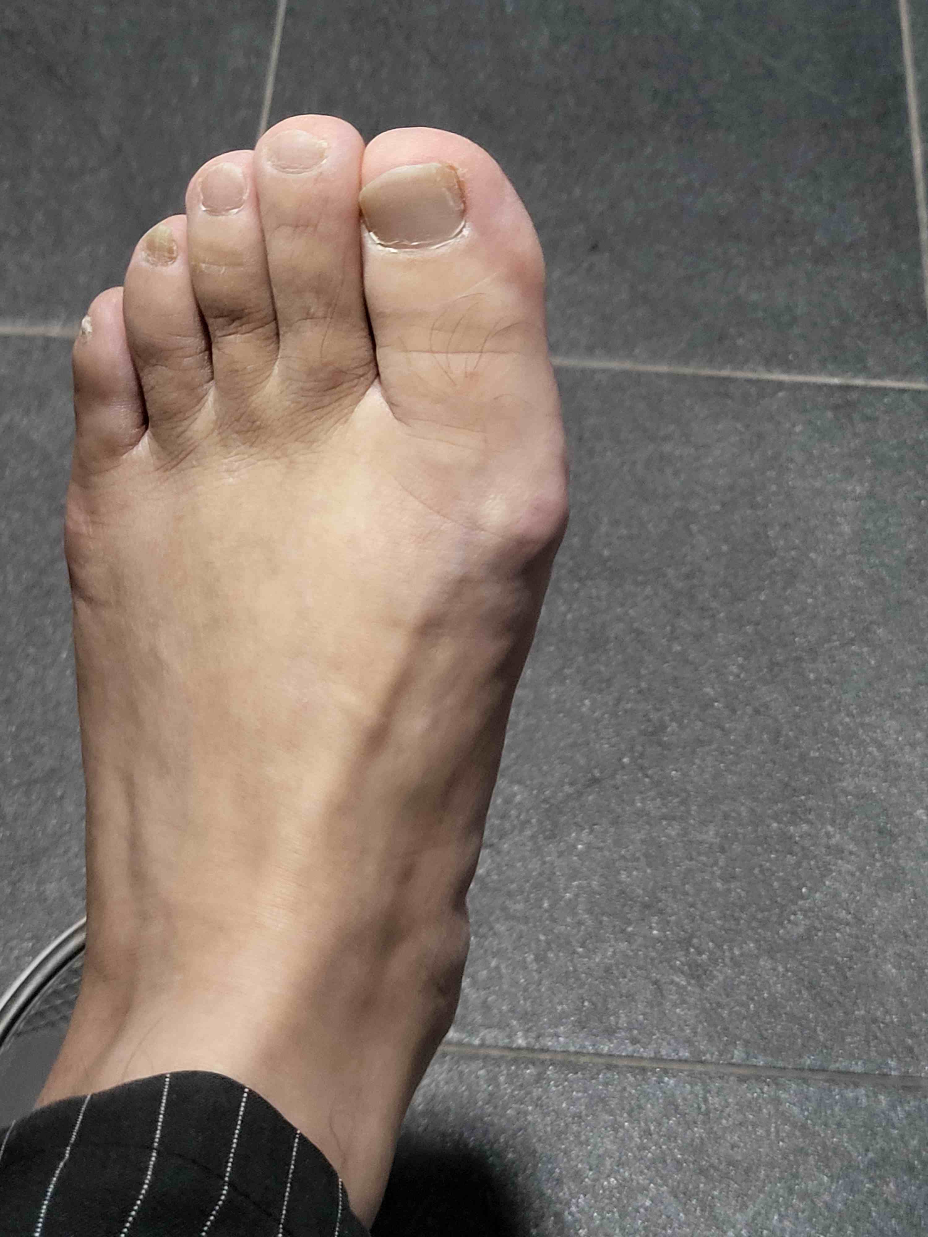 통풍초기증상