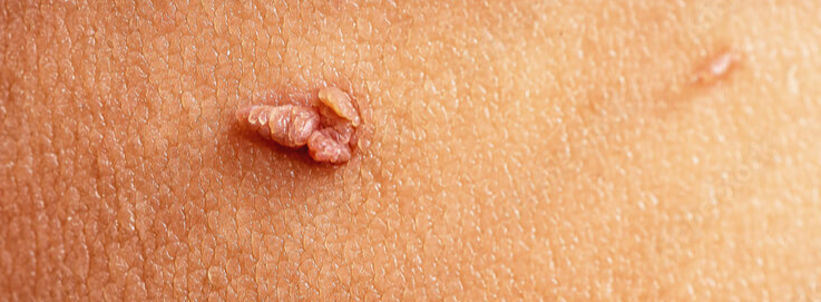 쥐젖 쥐젖 제거 쥐젖 원인 쥐젖 연고 쥐젖 패치 쥐젖 사과식초 피부 섬유종 쥐젖 치료 조합 키워드 쥐젖 생기는 이유 쥐젖 제거 방법 쥐젖 제거 비용 쥐젖 자연 제거 쥐젖 사과식초 효과 쥐젖 제거 연고 추천 쥐젖 냉동 치료 쥐젖 레이저 제거 쥐젖 패치 사용법 쥐젖 제거 후 관리법