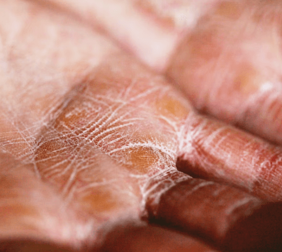 모공각화증 치료방법 - 박피 치료