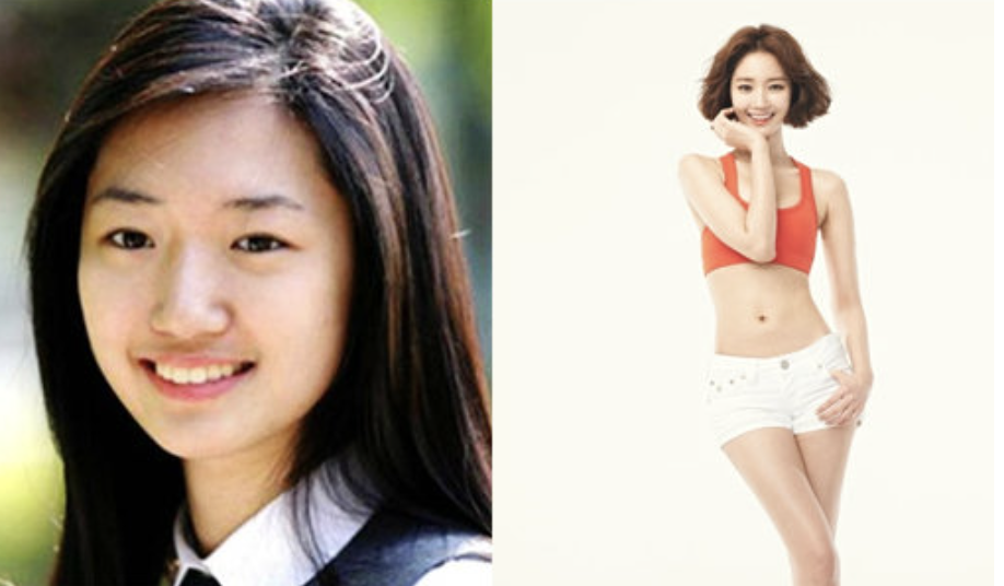 배우 고준희 성형