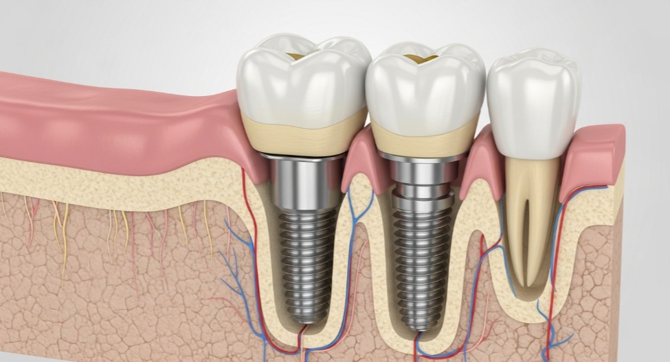 임플란트 본인부담금