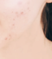 염증수치 낮추는 방법