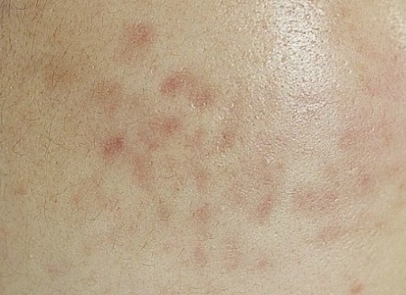 기미 잡티 제거