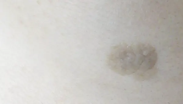 노인성 사마귀