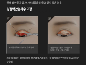 여자 무쌍 눈매 교정