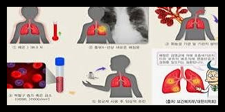 폐렴 예방접종 가격 시기